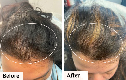 Before & After PRFM hair restoration